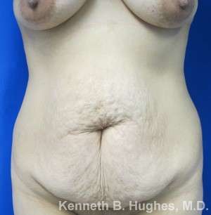 Mommy Makeover Before & After Patient #9960
