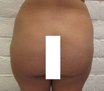 Brazilian Butt Lift Before & After Patient #6307