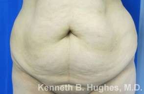 Mommy Makeover Before & After Patient #9966