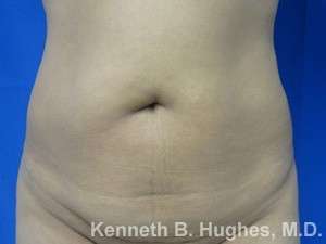 Mommy Makeover Before & After Patient #9969