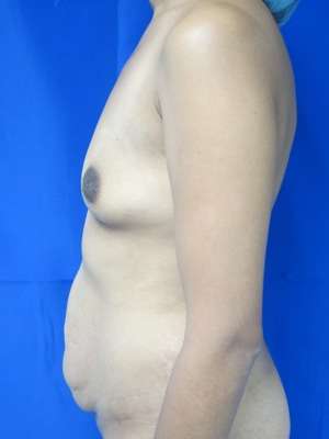 Mommy Makeover Before & After Patient #9989