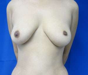 Mommy Makeover Before & After Patient #9992