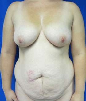 Mommy Makeover Before & After Patient #9995