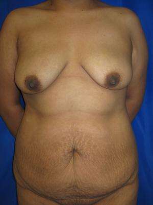 Mommy Makeover Before & After Patient #9998