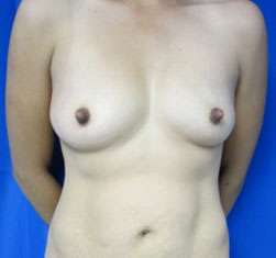 Mommy Makeover Before & After Patient #10001