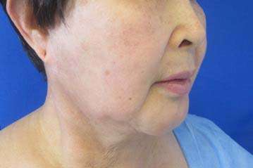 Neck Lift Before & After Patient #10018