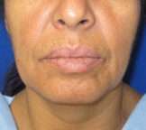 Neck Lift Before & After Patient #10021