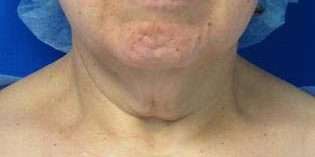 Neck Lift Before & After Patient #10026