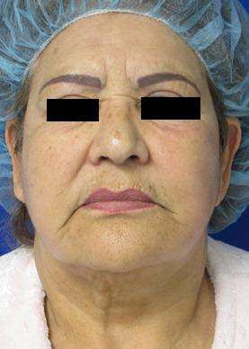Neck Lift Before & After Patient #10044