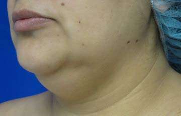 Neck Lift Before & After Patient #10049