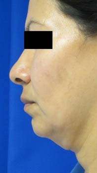Neck Lift Before & After Patient #10060