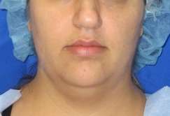 Neck Lift Before & After Patient #10063
