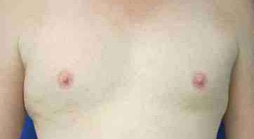 Pec Implants Before & After Patient #10068