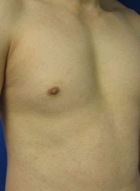 Pec Implants Before & After Patient #10073