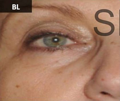 PRP for Facial Rejuvenation Before & After Patient #10078