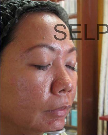 PRP for Facial Rejuvenation Before & After Patient #10081