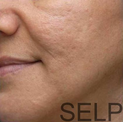 PRP for Facial Rejuvenation Before & After Patient #10084