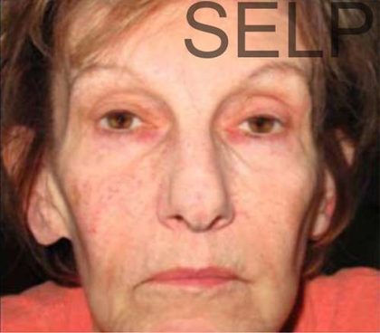 PRP for Facial Rejuvenation Before & After Patient #10090