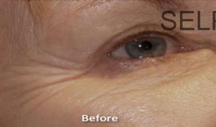 PRP for Facial Rejuvenation Before & After Patient #10093