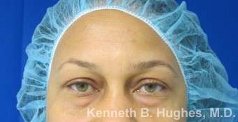 Rhinoplasty Before & After Patient #10096
