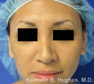 Rhinoplasty Before & After Patient #10099