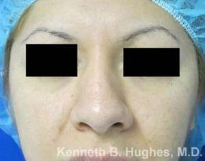 Rhinoplasty Before & After Patient #10102