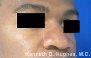 Rhinoplasty Before & After Patient #10110