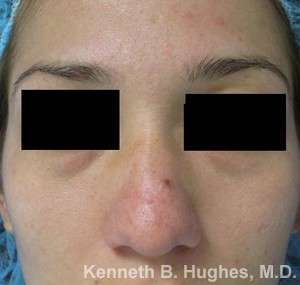 Rhinoplasty Before & After Patient #10113