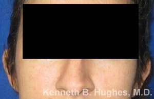 Rhinoplasty Before & After Patient #10116