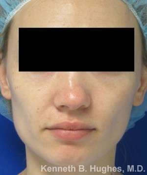 Rhinoplasty Before & After Patient #10119