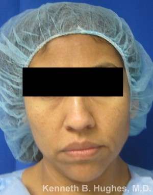 Rhinoplasty Before & After Patient #10122