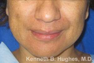 Rhinoplasty Before & After Patient #10125
