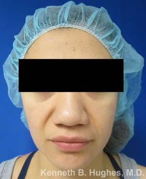 Rhinoplasty Before & After Patient #10128