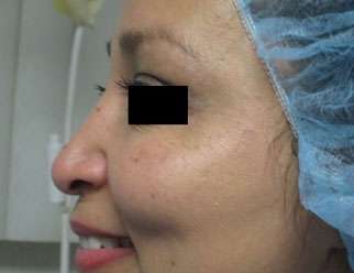 Rhinoplasty Before & After Patient #10131