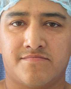 Rhinoplasty Before & After Patient #10134
