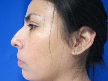 Rhinoplasty Before & After Patient #10137