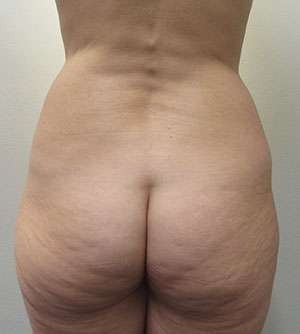 Brazilian Butt Lift Before & After Patient #6326