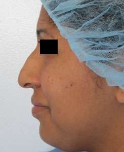 Rhinoplasty Before & After Patient #10147