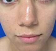 Rhinoplasty Before & After Patient #10155