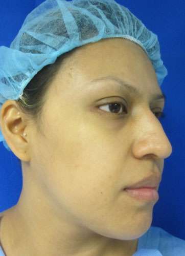 Rhinoplasty Before & After Patient #10158