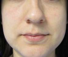 Rhinoplasty Before & After Patient #10161
