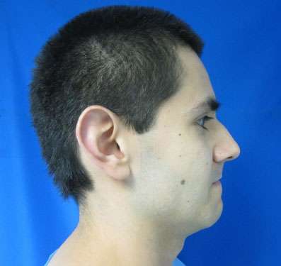 Rhinoplasty Before & After Patient #10164