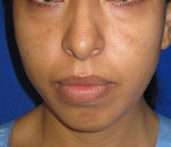 Rhinoplasty Before & After Patient #10167