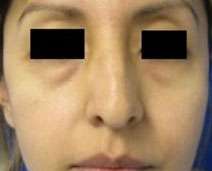 Rhinoplasty Before & After Patient #10170