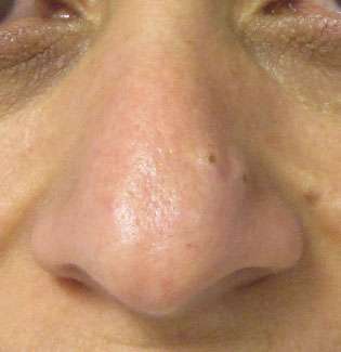 Rhinoplasty Before & After Patient #10175