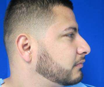 Rhinoplasty Before & After Patient #10183