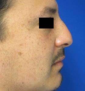 Rhinoplasty Before & After Patient #10188