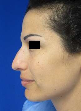 Rhinoplasty Before & After Patient #10191