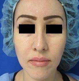 Rhinoplasty Before & After Patient #10196