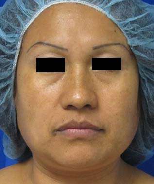 Rhinoplasty Before & After Patient #10204